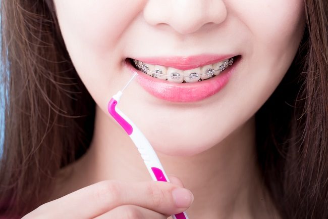 Cara Merawat Gigi untuk Pemakai Pendakap Gigi