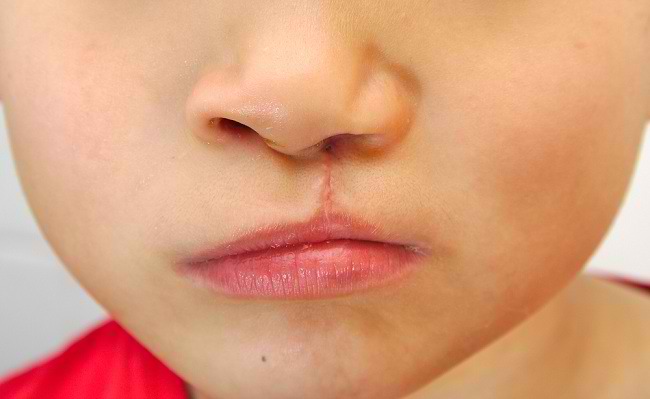 Conoscere le cause del labbro leporino e il loro trattamento
