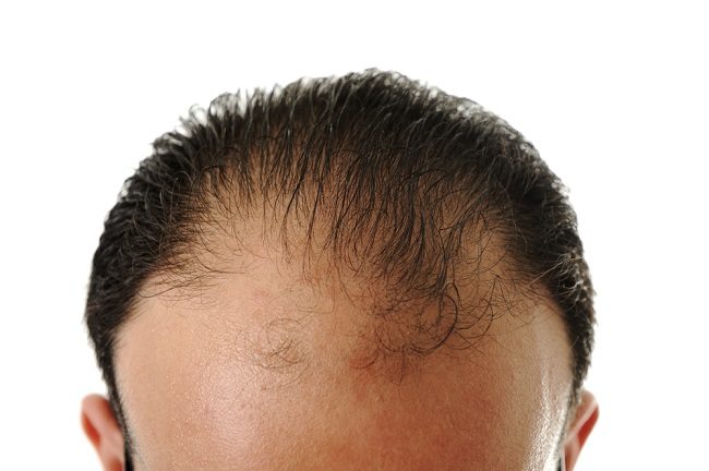 التعرف على الإجراءات الطبية المختلفة لنمو الشعر