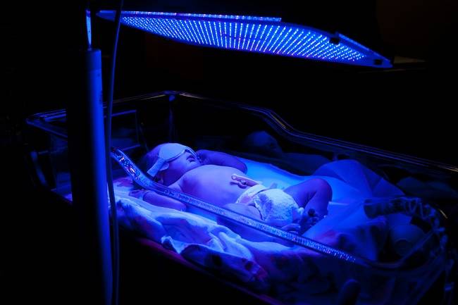 Ползите от фототерапията за жълти бебета