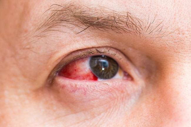 بقع حمراء في العين بسبب نزيف تحت الملتحمة ، هذه هي الأسباب والعلاج