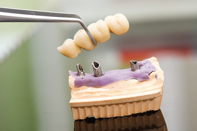 Comprensione del processo di installazione dell'impianto dentale e dei rischi