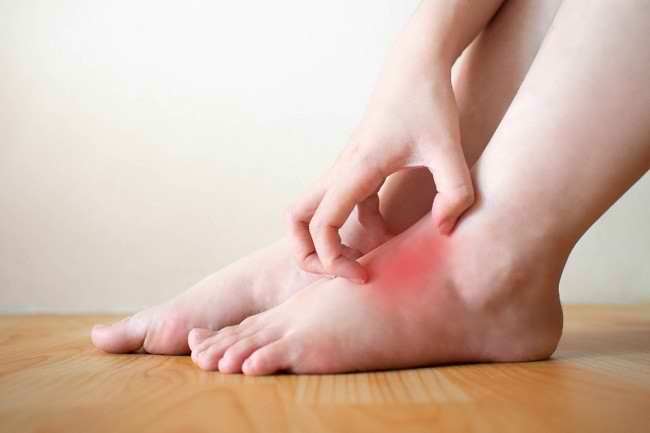 5 malattie della pelle dei piedi che devi conoscere