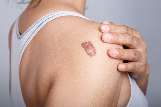 皮膚のさまざまな種類の傷跡とそれらを克服する方法