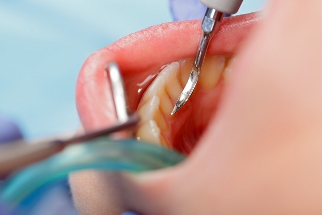 歯石の影響とそれを防ぐ方法は何ですか？