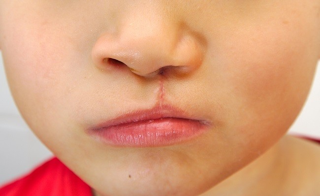 Неща, които трябва да знаете за хирургията на цепнати устни