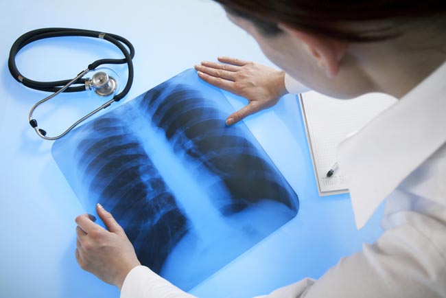 肺の専門家が治療する病気の種類と手順