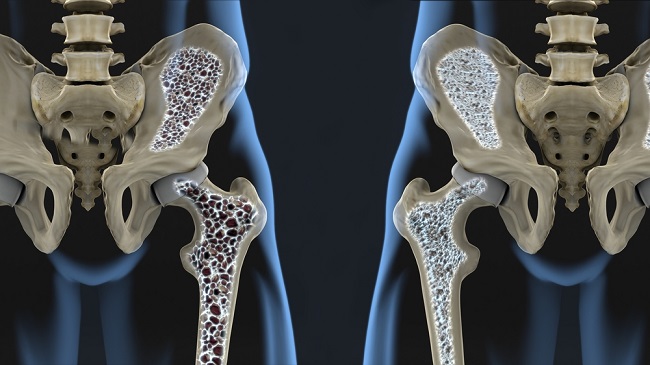 Знайте видовете остеопороза и как да ги предотвратите