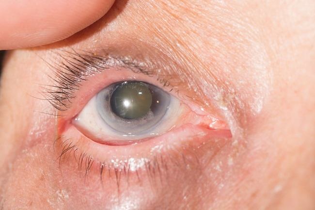 Причини за ядрена катаракта и как да се лекува