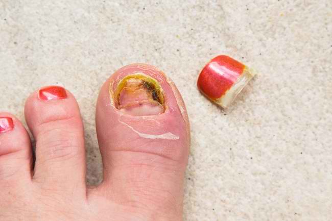 Причини за синдром на жълтите нокти и лечение